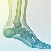 Ankle Surgery